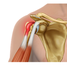 Physiotherapy LHB tenodesis leaflet